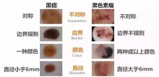 黑痣肿瘤,黑痣恶变的人