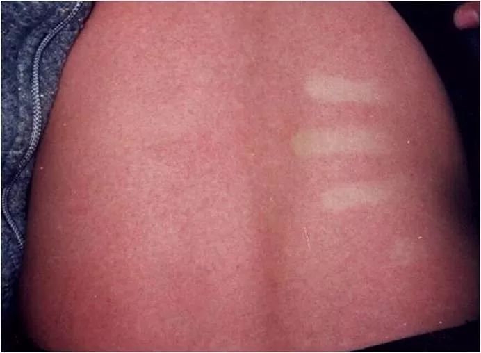 发热出红疹子可以吃过敏药吗,发热皮疹会反复么