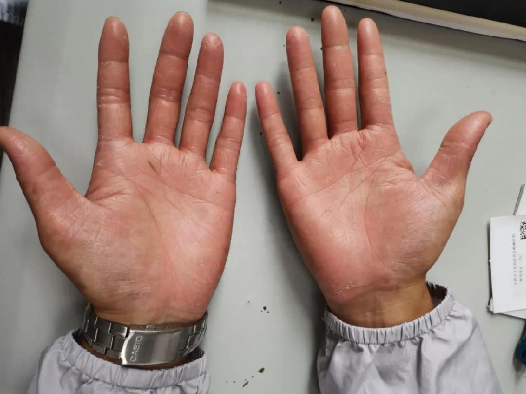 皮肤湿疹的中医辨证论治,皮癣湿疹用什么药膏