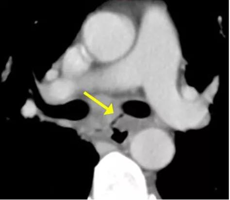 一碗鱼汤,让她反复咳嗽、发烧,还发生了食管、气管“短路”