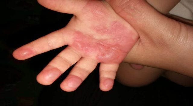 手指每年春天就起泡脱皮怎么治疗,宝宝手指起泡后反复脱皮