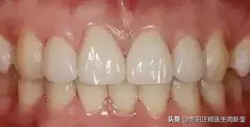 牙齿以前齐现在不齐是什么原因,牙齿排列整齐牙缝大前门牙凸