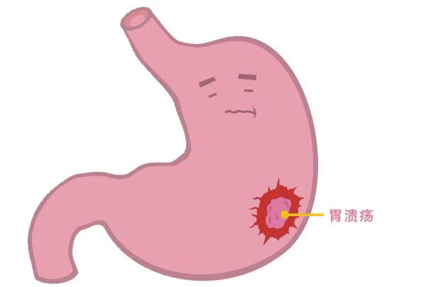 糜烂性胃炎真的是胃烂了嘛,糜烂性胃炎胃食道反流原因