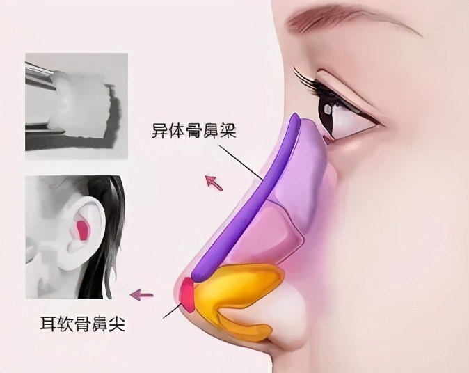 鼻部太瘦做鼻综合效果怎样,鼻尖塑形和鼻头缩小是一种手术吗