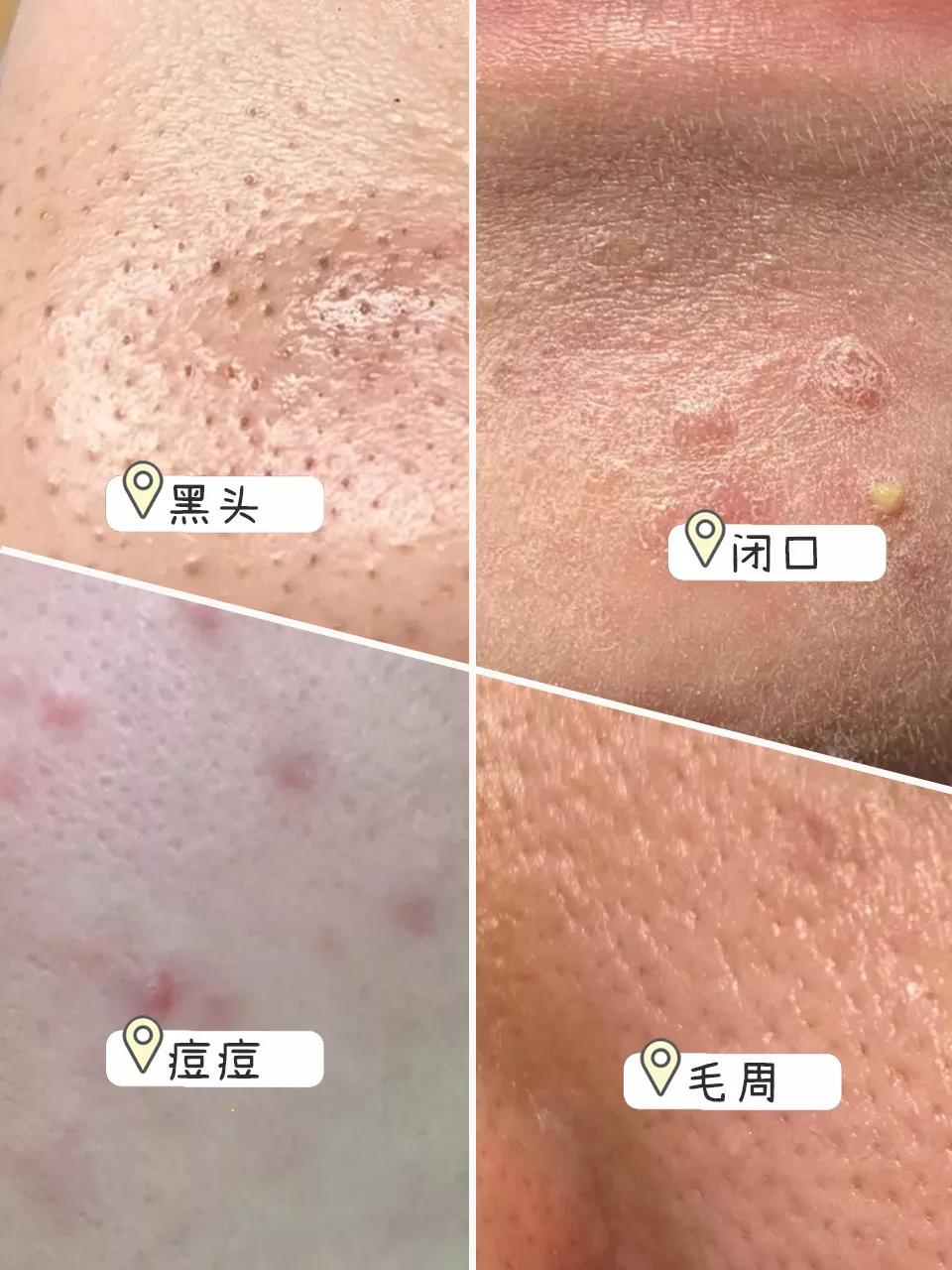 生理盐水把痘消了,去痘痘黑头和痘印