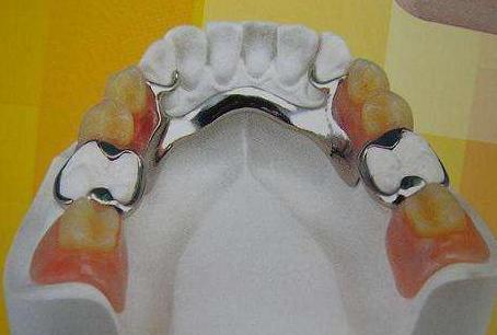 缺牙该怎么办,缺牙了怎么办