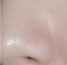 鼻头毛孔粗大如何改善缩小毛孔,皮肤毛孔粗大出汗可以缩小毛孔吗