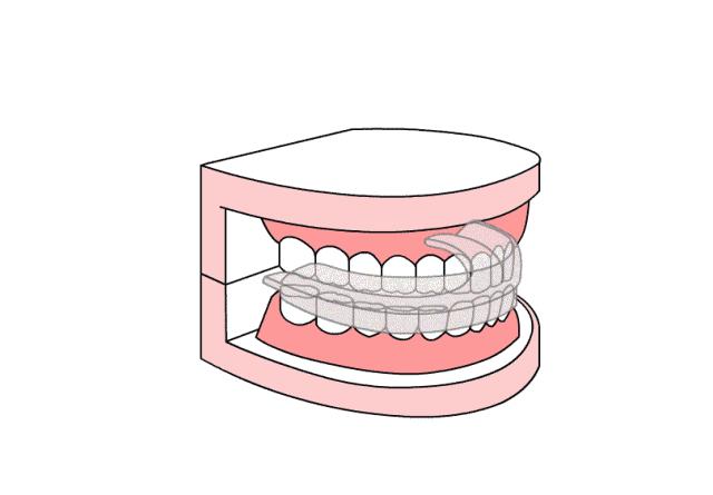 上下颚咬合耳根处疼痛带耳鸣,耳鸣愈发严重