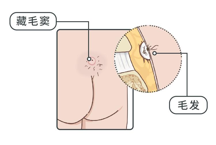 不同部位长痘痘的原因及解决方法,不同地方长痘痘的原因和改善方法