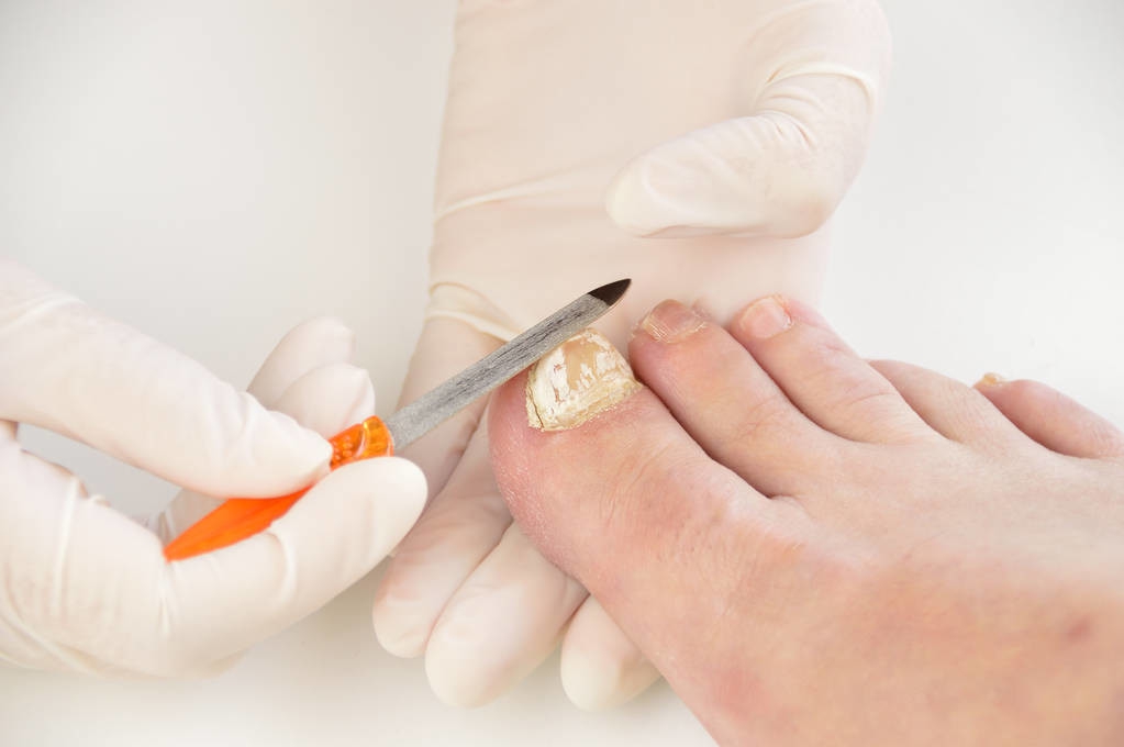 灰指甲反复发作怎么彻底治愈,灰指甲反复发作难以治愈怎么办