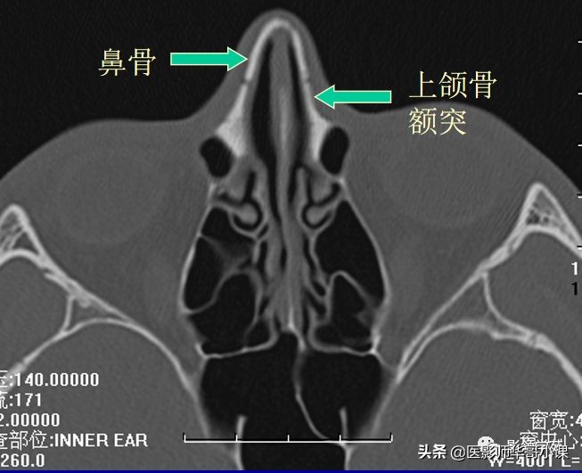 「鼻骨彩图」鼻骨CT解剖及骨折影像学诊断