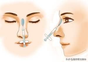 想去隆鼻,隆鼻到底值不值得入手