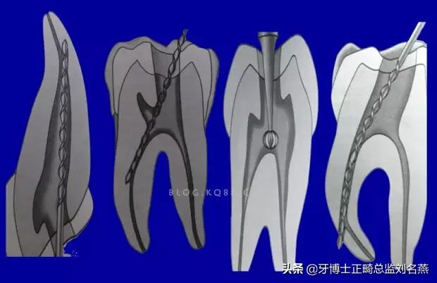 根管治疗难点与解决方案,根管治疗牢固吗