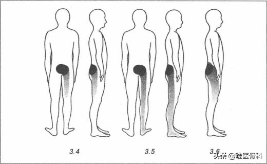 腰椎间盘突出手术后多久可以跑步,患了腰椎间盘突出还能跑步吗