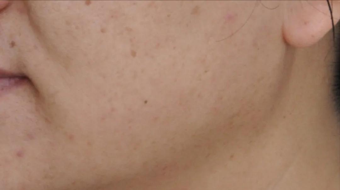 解密瘦脸针的几大常识性问题,关于瘦脸针的几个常识问题