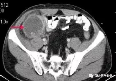 阑尾的ct解读与影像诊断技巧,阑尾影像学基础知识