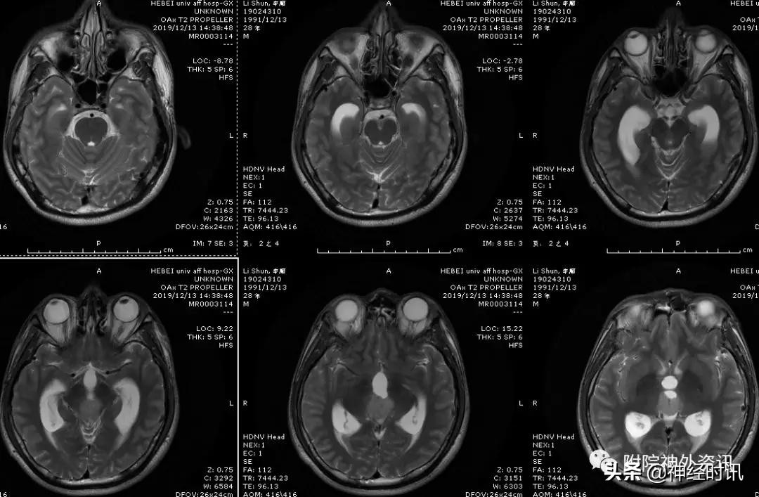 松果体占位怎样治疗,松果体区占位看什么科室