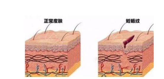 十大祛妊娠纹产品排行榜,妊娠纹产品哪个效果好