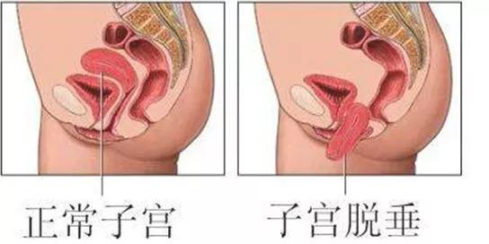 女性的腰痛要警惕四种原因,女性左侧腰痛需警惕3种妇科疾病