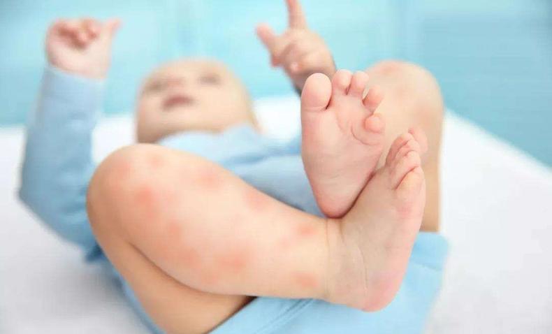 宝宝身上起疹子还拉肚子怎么回事,小孩腹泻身上起疹子怎么治疗