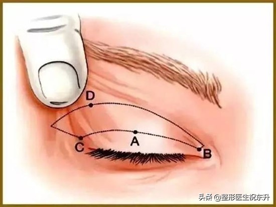 当你老了，上眼皮松了，其实恢复年轻并不难...