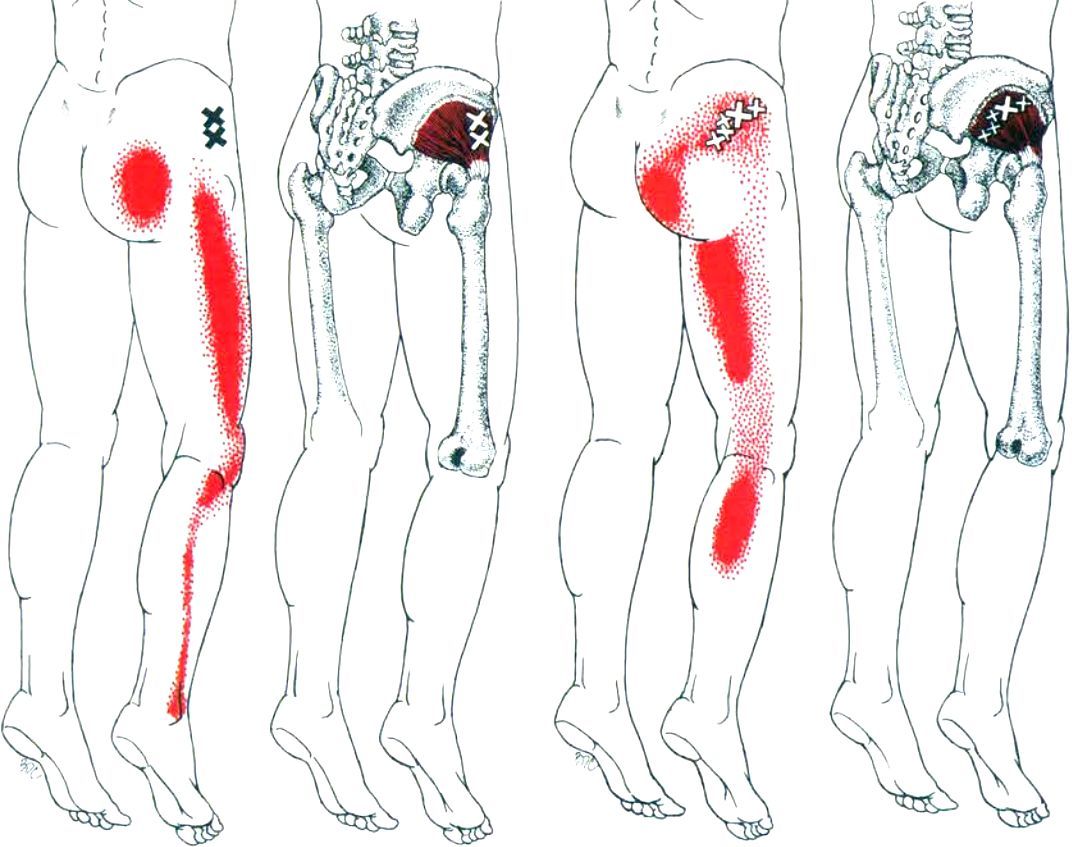 躺着蚌式开合练臀标准姿势,蚌式开合激活臀中小肌