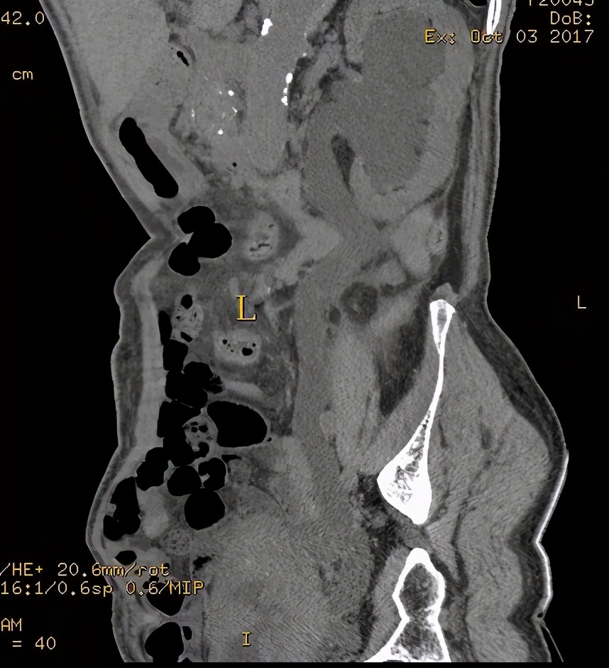 尿路造影输尿管间断显影,静脉尿路造影和排泄性尿路造影