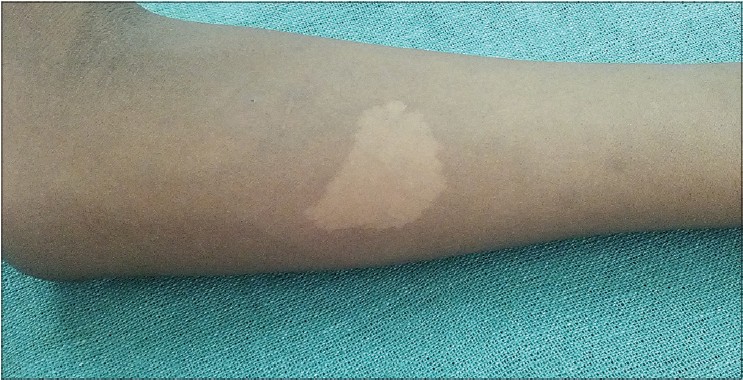 白斑是白癜风吗医生为你详解,得了白癜风感觉身上都是白斑