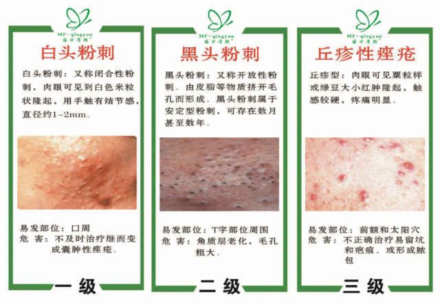 战痘小绝招科学祛痘让你少走弯路,两三年的痘印怎么祛痘好