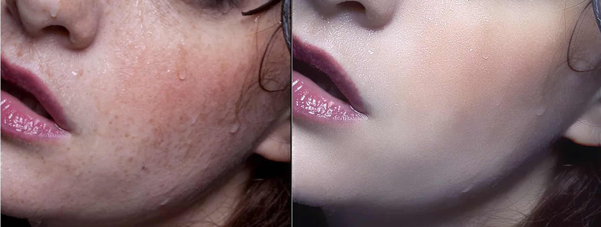 皮肤发炎屏障受损怎么修复,脸部皮肤屏障受损怎么修复