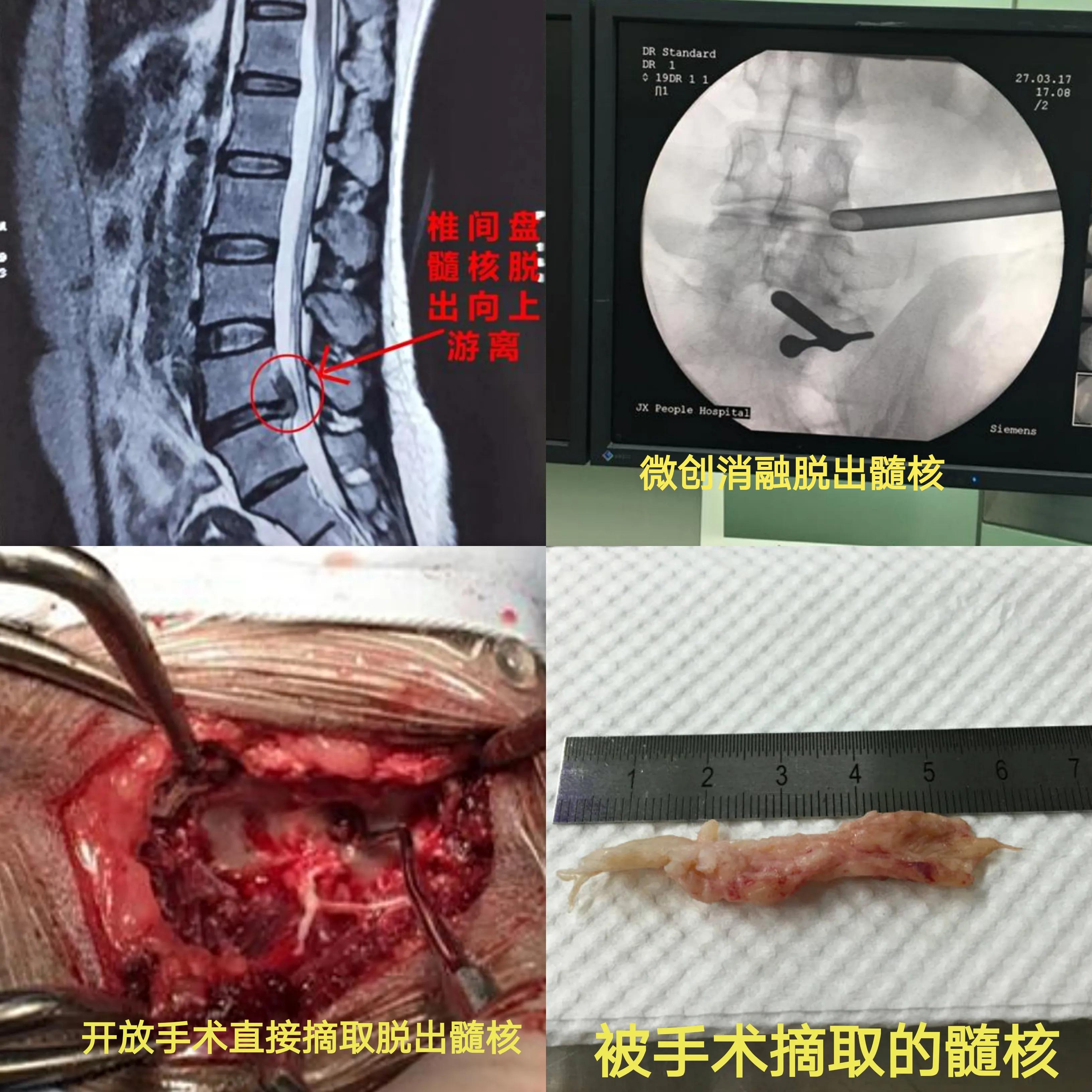 腰椎脱出疼痛腿麻肌萎缩必须手术？中医针药并用显奇效！