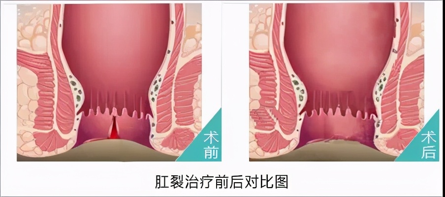每次大便就像拉肚子一样,每次大便拉出来跟粥一样