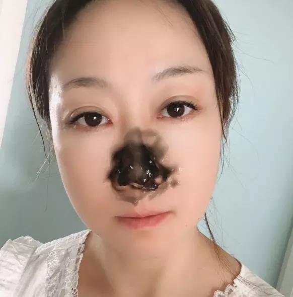 鼻头怎么才不出油,大油鼻头怎么改善