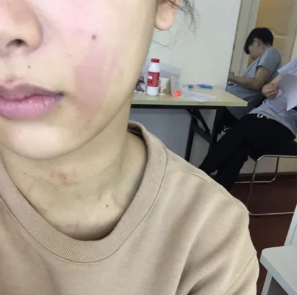 脸一换季就过敏怎么办,换季脸部过敏最快的补救方法