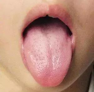 宝宝舌头地图舌是怎么回事,宝宝舌头辨别疾病图片