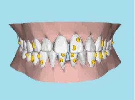 牙龈里的黑东西是什么,牙龈间有黑东西怎么办