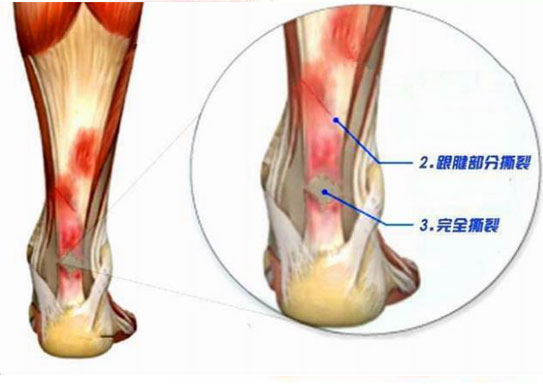运动员腰和腿都受伤,运动员骨头受伤