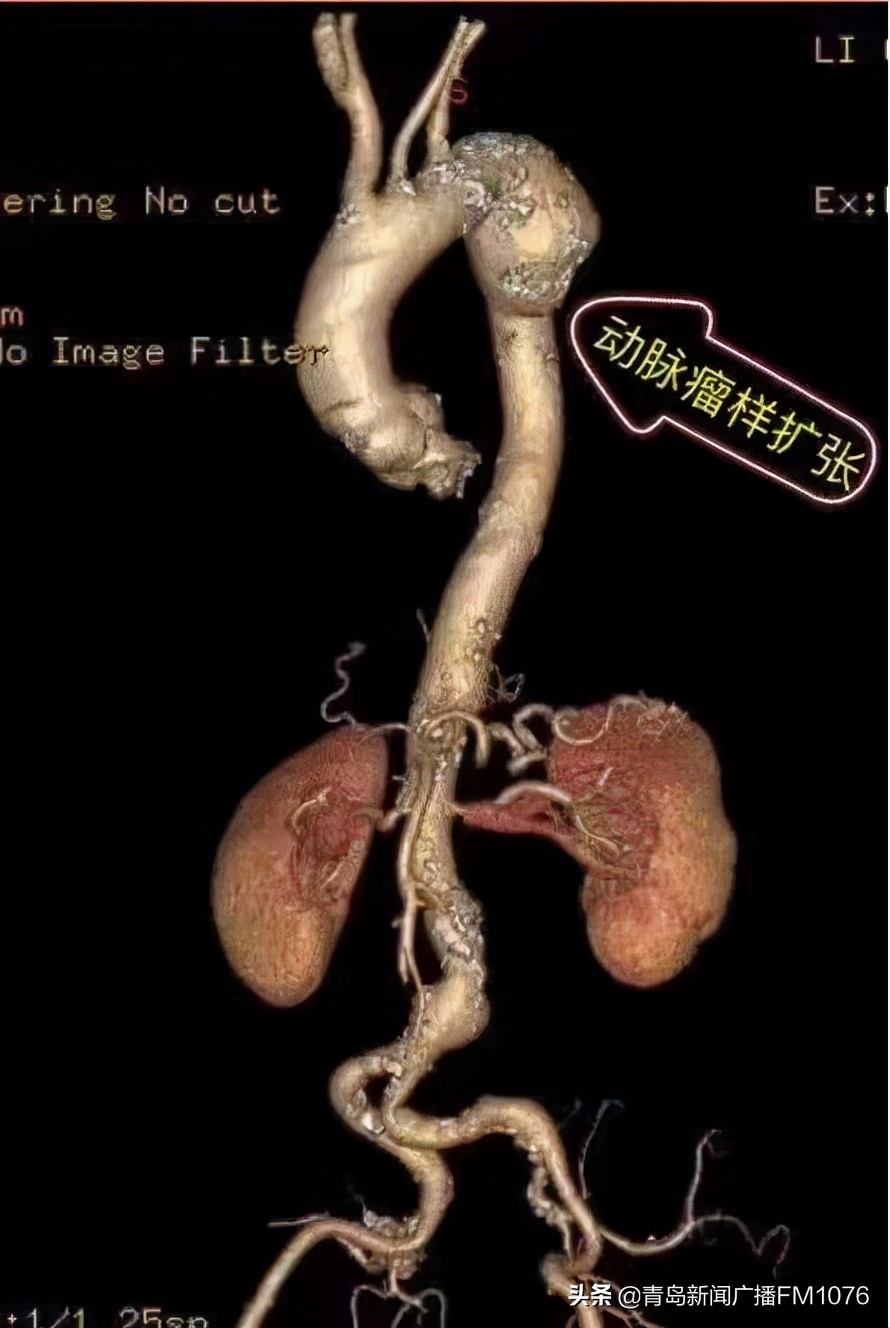 海慈血管外科中心开展高难度杂交手术为患者解除胸主动脉弓动脉瘤危机