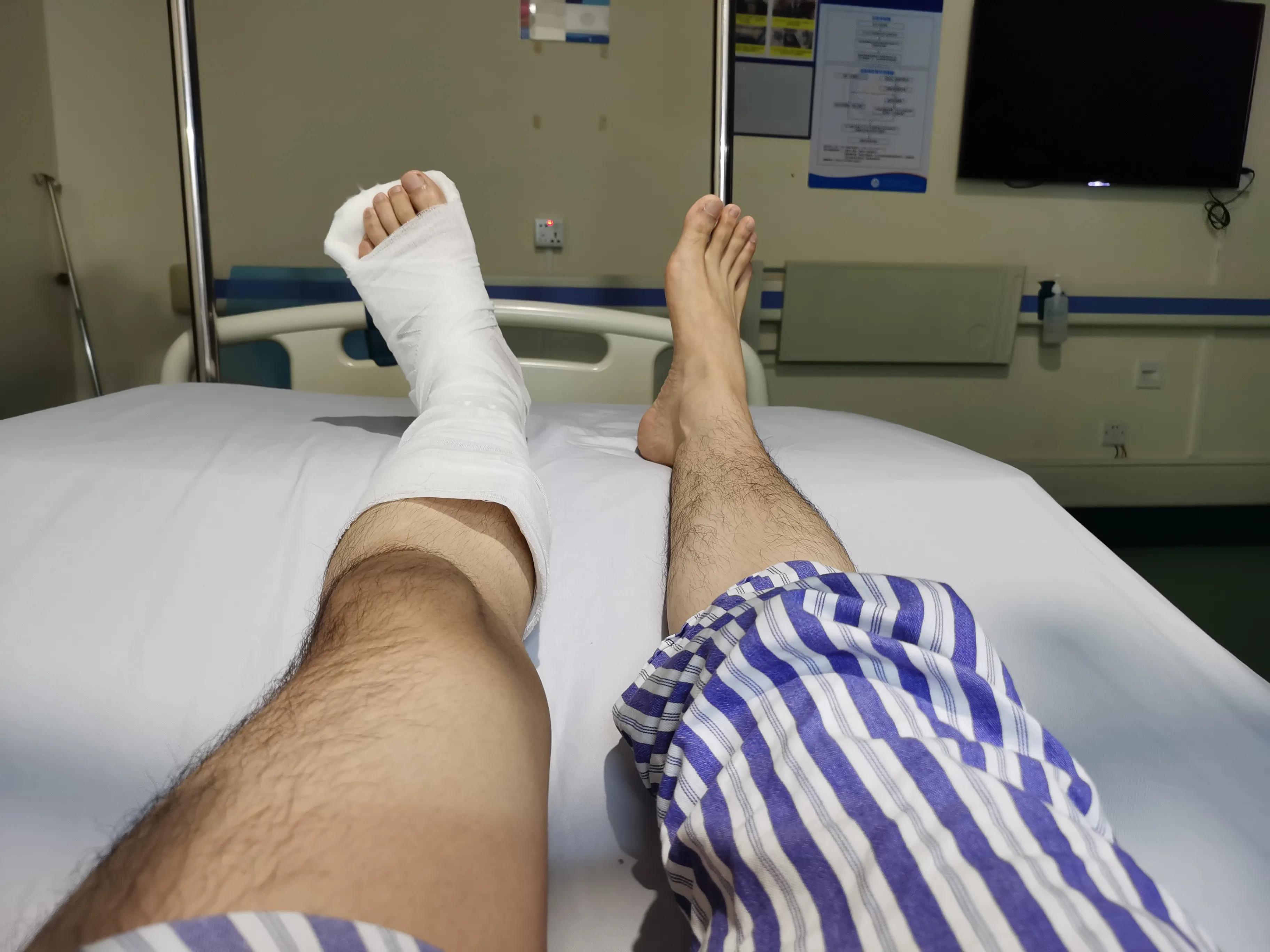 第五跖骨粉碎性骨折多久后能走路,第五跖骨基底骨折100天了走路肿