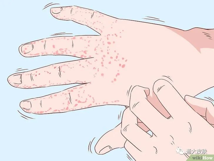 人老了身上为什么会长疮,人老了长疣什么原因