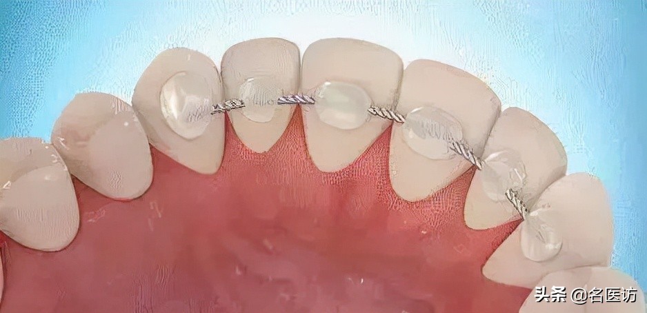 儿童牙齿矫正后要终身戴保持器吗,牙齿矫正戴保持器后还需要复诊吗