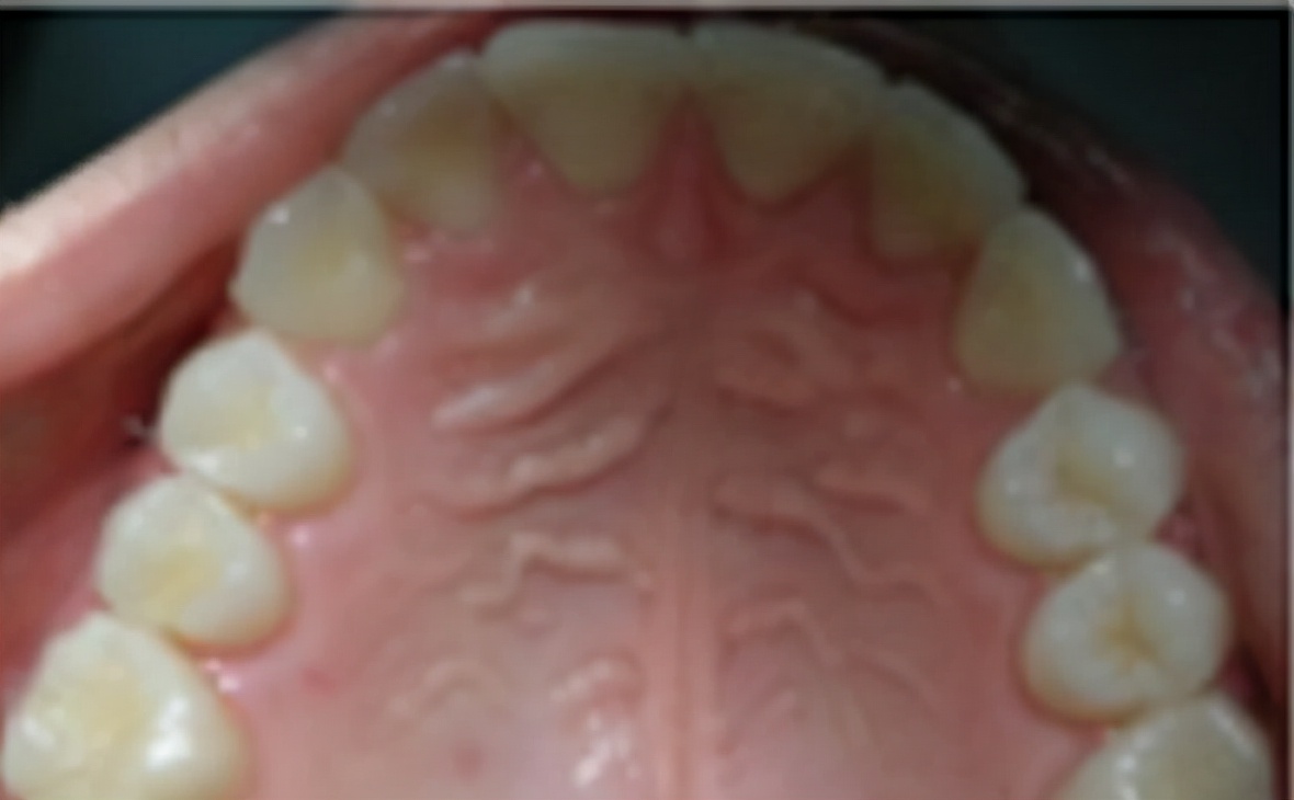 口腔内壁凹凸不平图片,口腔内壁凹凸不平褶皱