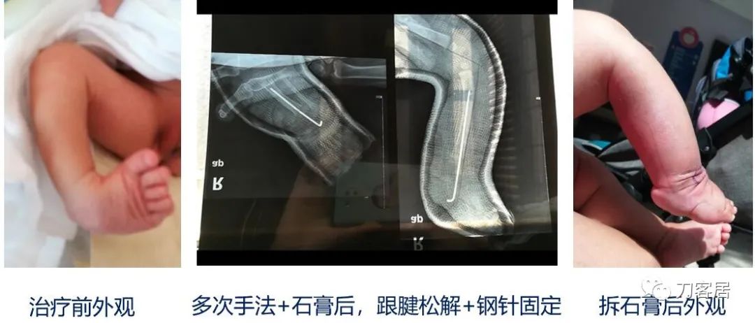 一个脊柱外科医生与马蹄内翻足的纠缠-写在6.3国际马蹄内翻足日前