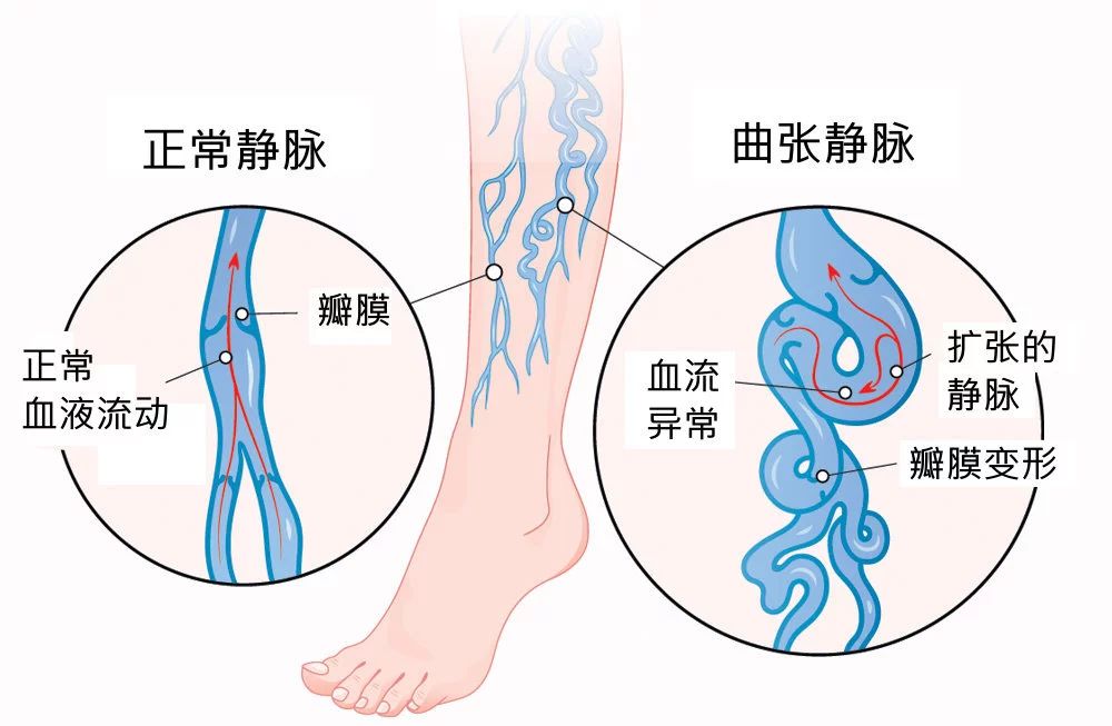小腿有静脉曲张是血管淤堵吗,静脉曲张血管堵塞有什么症状