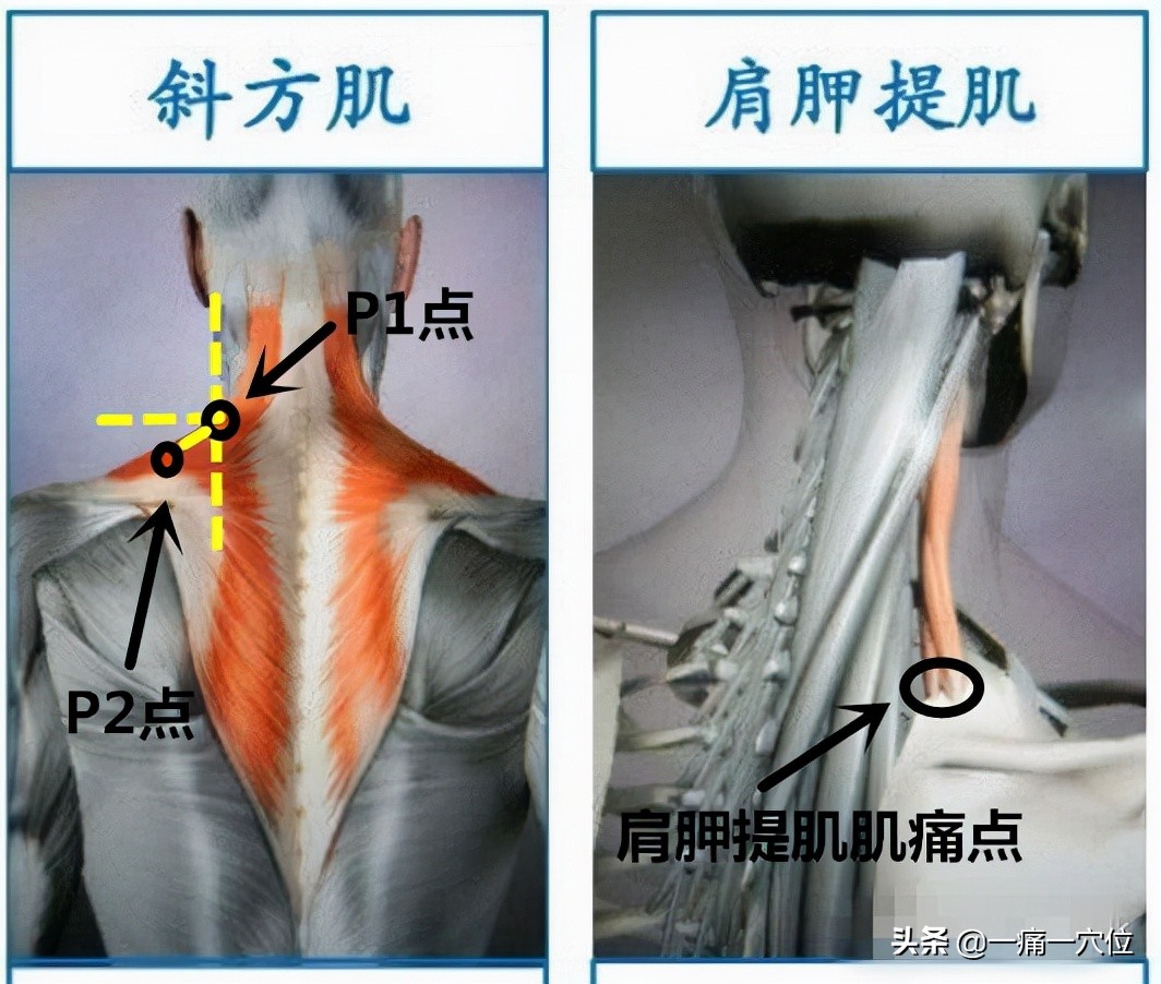 颈肩困痛怎么办,颈肩综合征自我锻炼方法