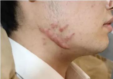 下颌交界长痘痘的正确消除方法,下颌线两侧痘痘反反复复怎么调理