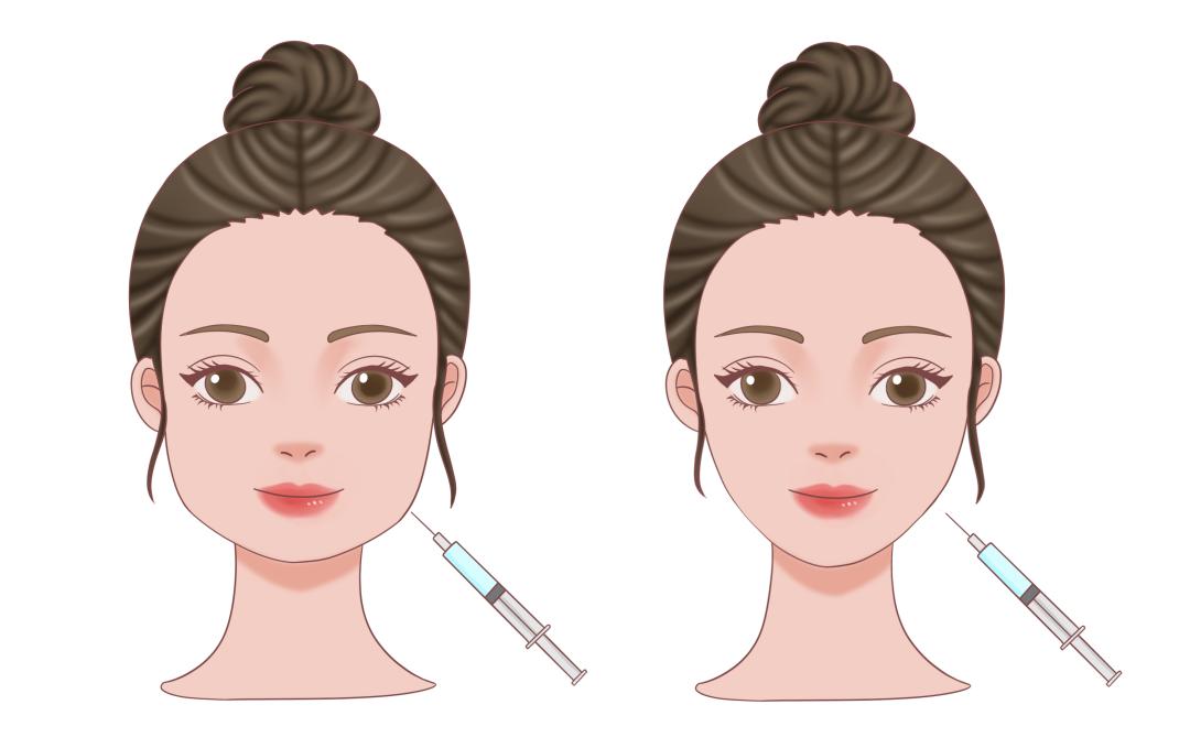 医美针剂注射方法,医美针剂注射项目有哪些