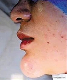 医美避过的坑,医美注射填充常见问题