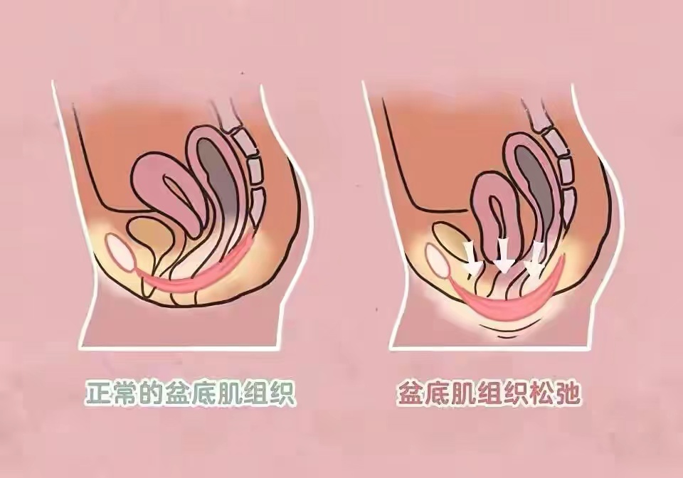 改善盆底肌的正确方法,一招教你如何找到盆底肌