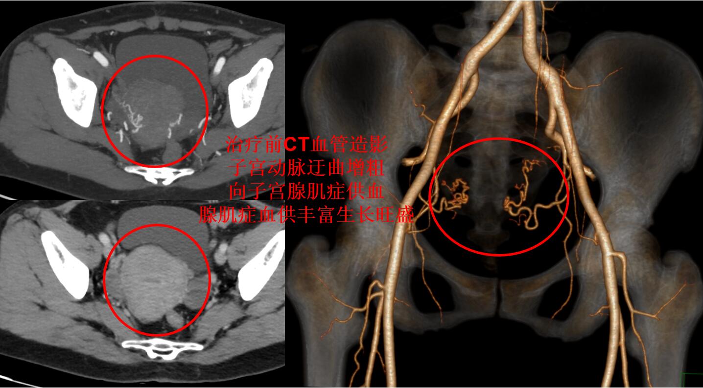 心脏做了大手术寿命能正常吗,心脏做过手术需要常年吃药吗